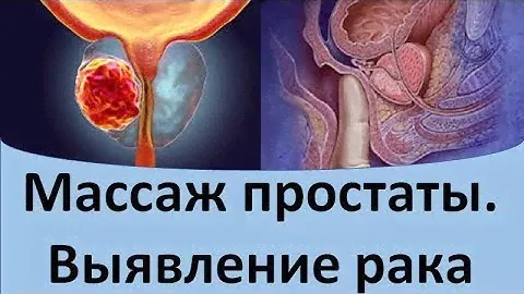 Как можно самому сделать массаж простаты: правила, техники. @Dr.urolog